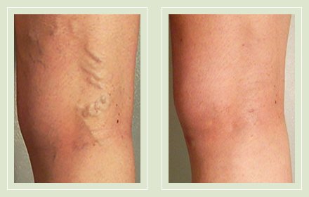 Фото до и после операции по удалению варикоза на ногах лазером