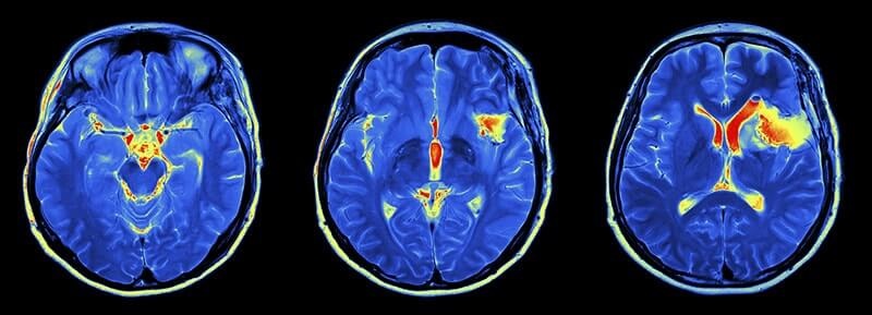 МРТ головного мозга с контрастом