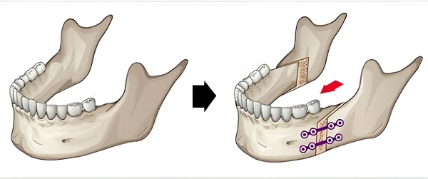 Остеотомия челюсти