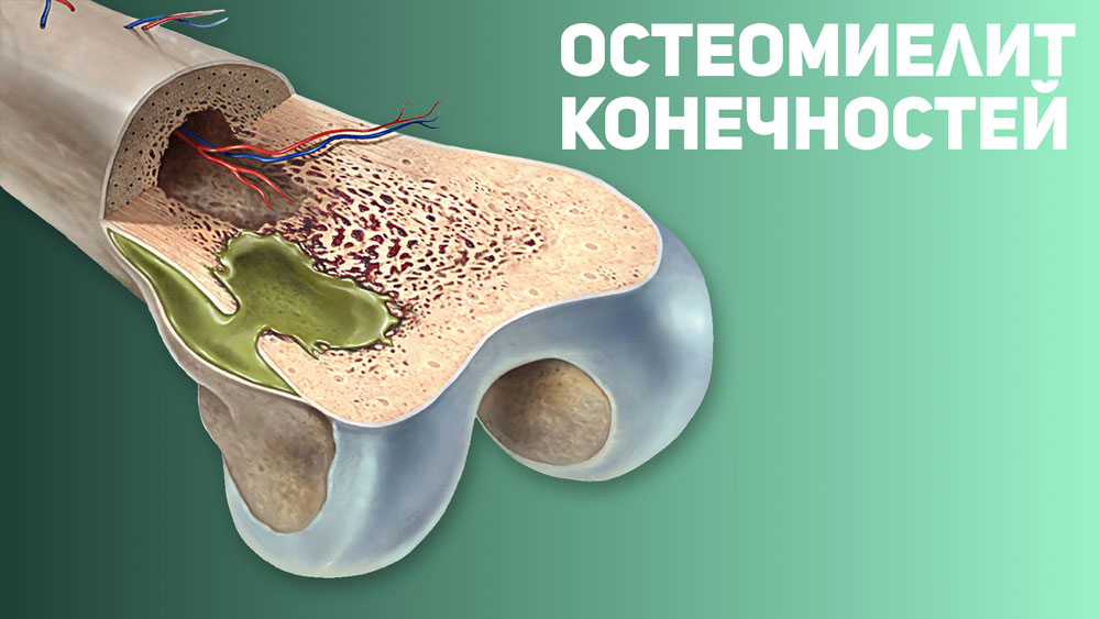 остеомиелит костной ткани