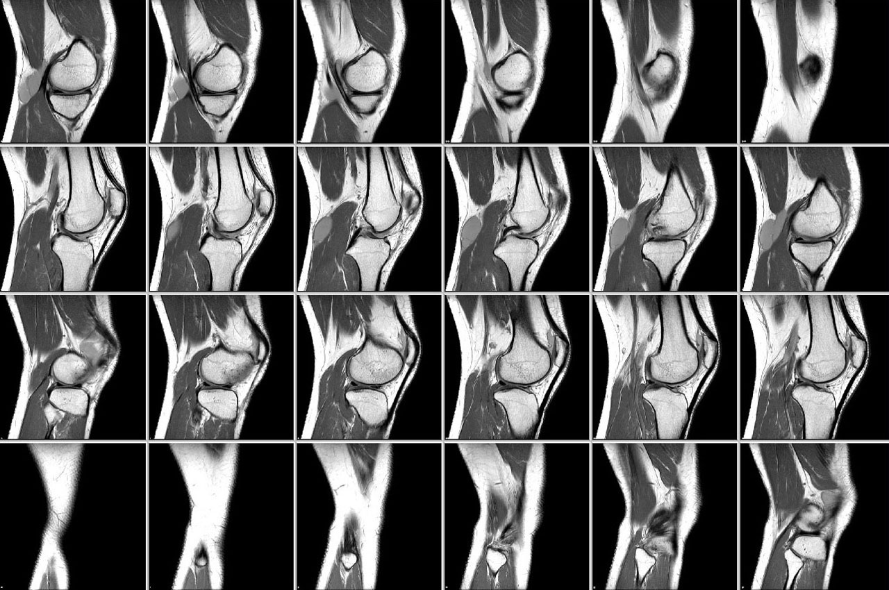 Компьютерная томография суставов