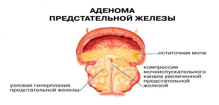 Лечение аденомы простаты (предстательной железы)