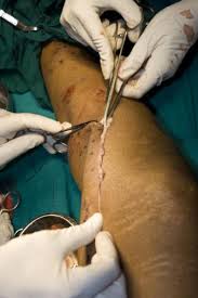Удаление варикоза на ногах методом сафенэктомии