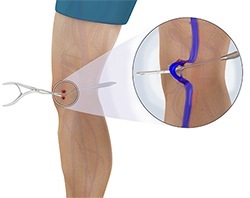 Удаление варикоза вен на ногах методом стриппинга
