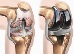 Изображение - Госпиталь вишневского эндопротезирование коленного сустава kneel2