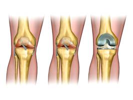 Изображение - Госпиталь вишневского эндопротезирование коленного сустава kneel3