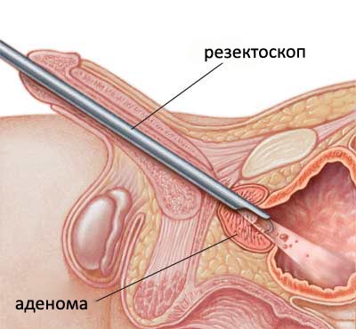operatsiya adenoma1