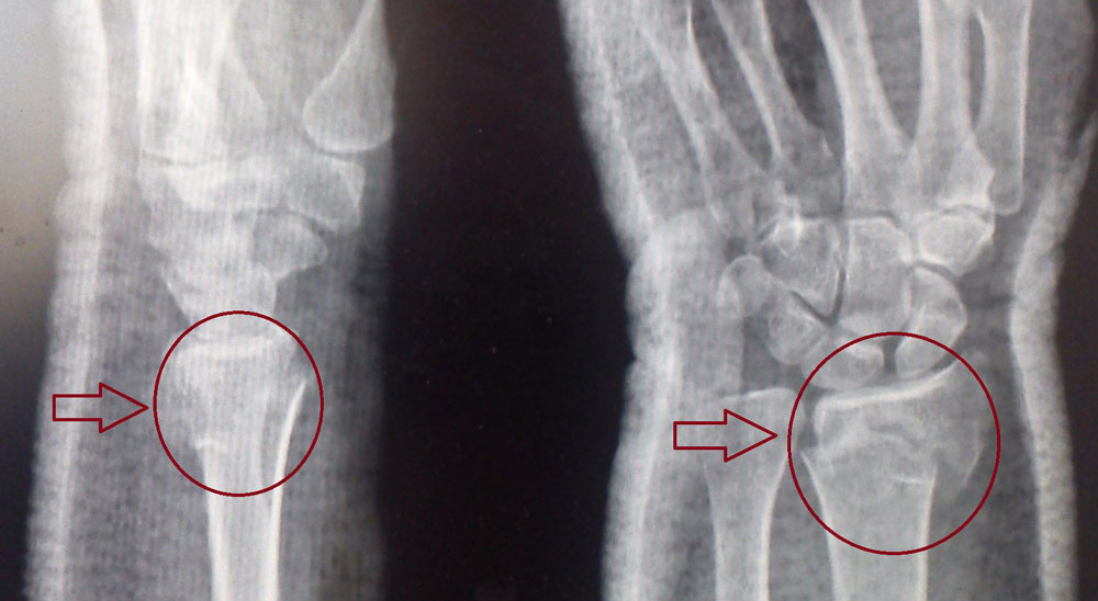 перелом лучевой кости в типичном месте