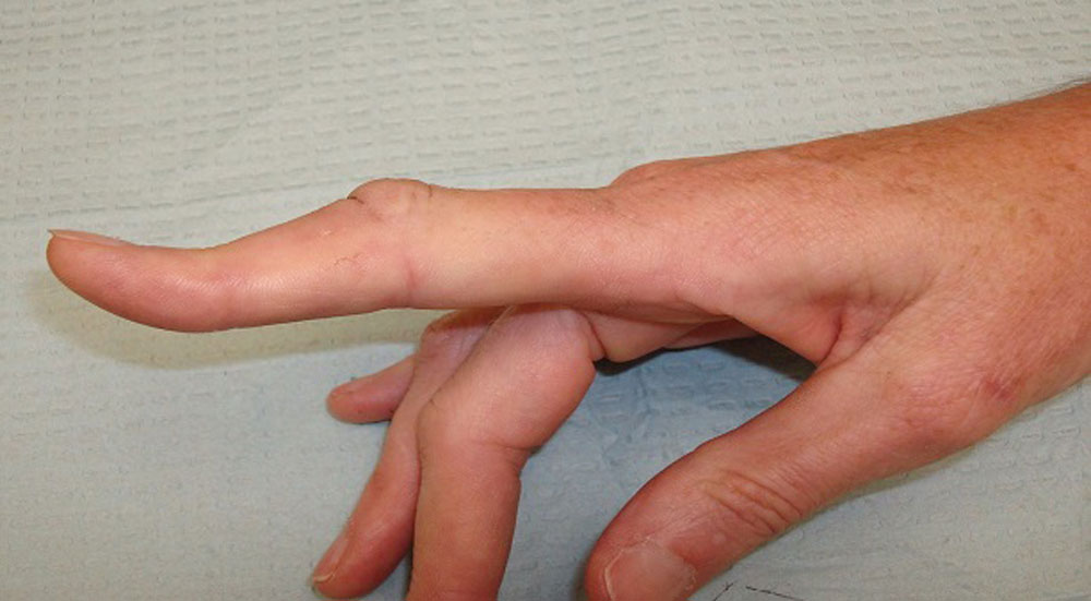 деформация пальца при повреждении сухожилия