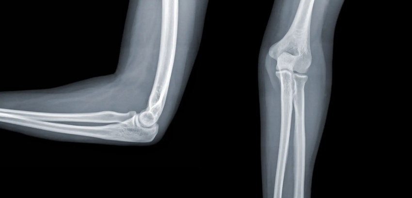 Рентген локтевого сустава