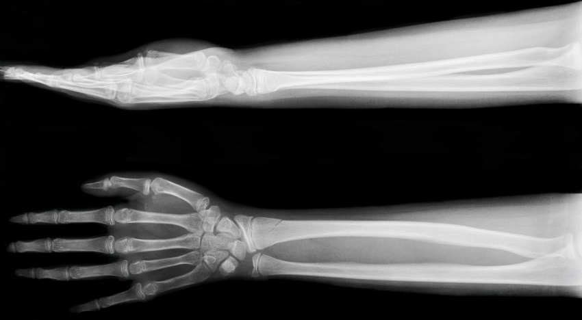 Рентген костей руки