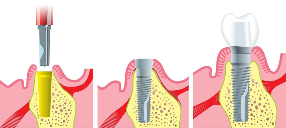 Этапы имплантации зуба