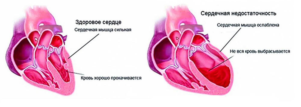 Почему сердце стучит: причины и способы улучшить сердечную работу