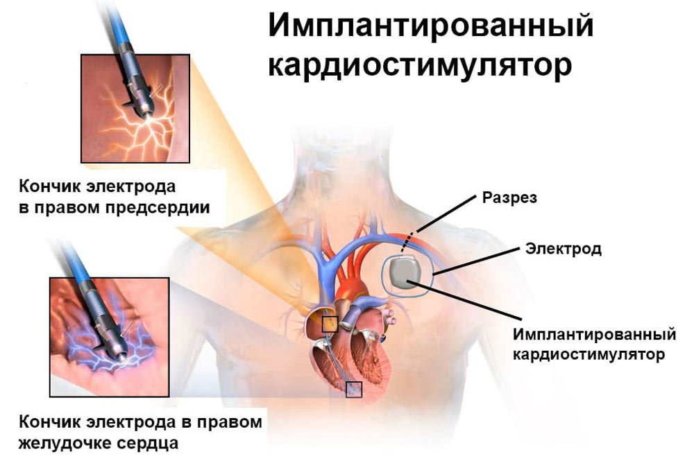 протезирование сердечного клапана